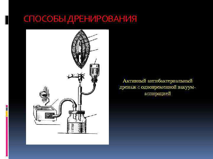 СПОСОБЫ ДРЕНИРОВАНИЯ Активный антибактериальный дренаж с одновременной вакуумаспирацией 