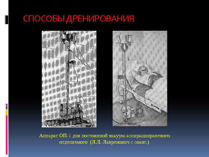 СПОСОБЫ ДРЕНИРОВАНИЯ Аппарат ОП-1 для постоянной вакуум-аспирациираневого отделяемого (Л. Л. Лавренович с соавт. )