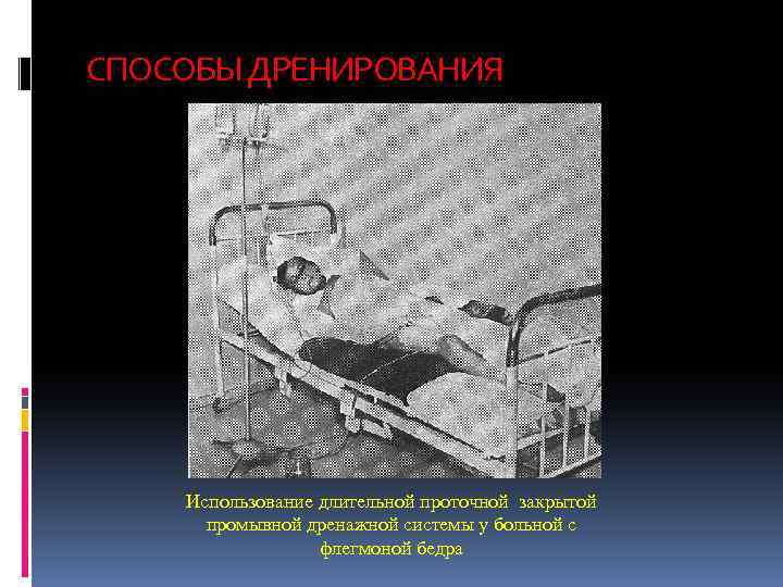 СПОСОБЫ ДРЕНИРОВАНИЯ Использование длительной проточной закрытой промывной дренажной системы у больной с флегмоной бедра