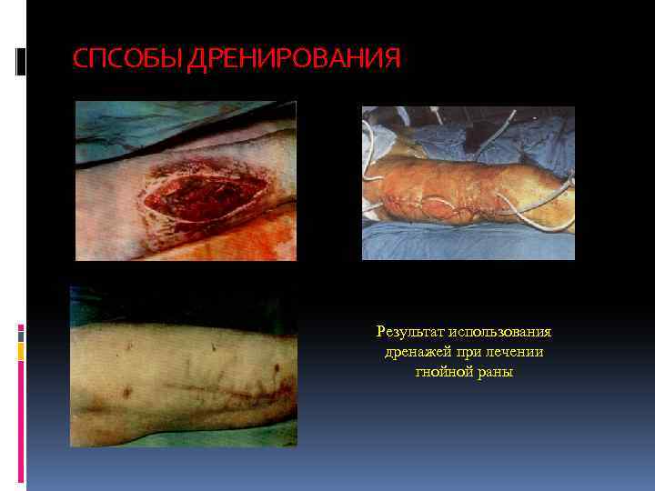 СПСОБЫ ДРЕНИРОВАНИЯ Результат использования дренажей при лечении гнойной раны 