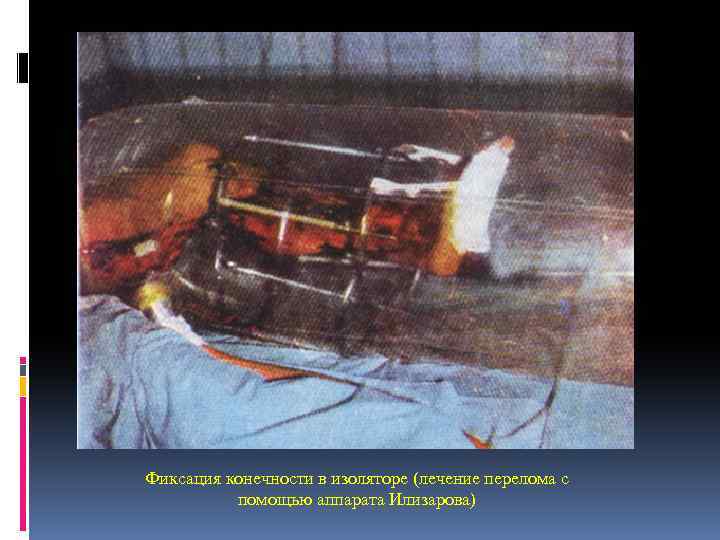 Фиксация конечности в изоляторе (лечение перелома с помощью аппарата Илизарова) 