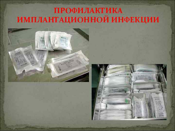 ПРОФИЛАКТИКА ИМПЛАНТАЦИОННОЙ ИНФЕКЦИИ 