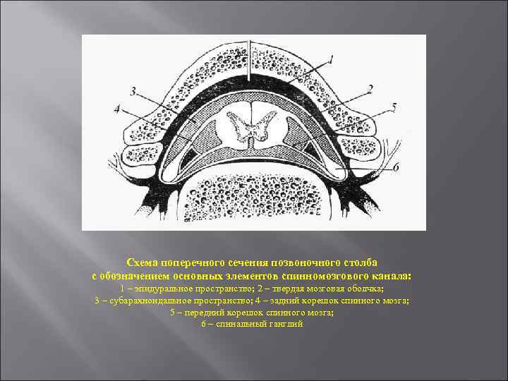 Схема поперечного сечения позвоночного столба с обозначением основных элементов спинномозгового канала: 1 – эпидуральное