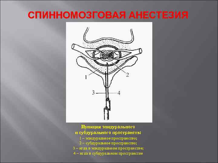 Спинномозговая анестезия. Спинномозговая пункция показания. Ориентиры при спинномозговой анестезии. Игла для пункции спинного мозга. Пункция эпидурального и субдурального пространства.