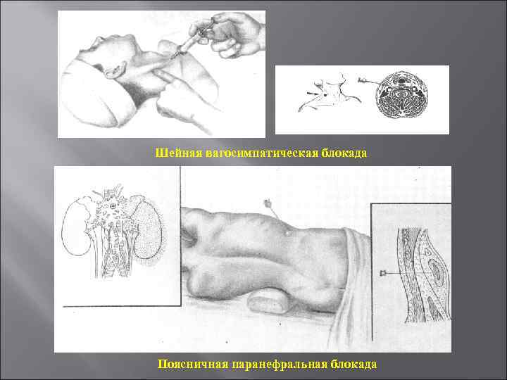 Шейная вагосимпатическая блокада Поясничная паранефральная блокада 