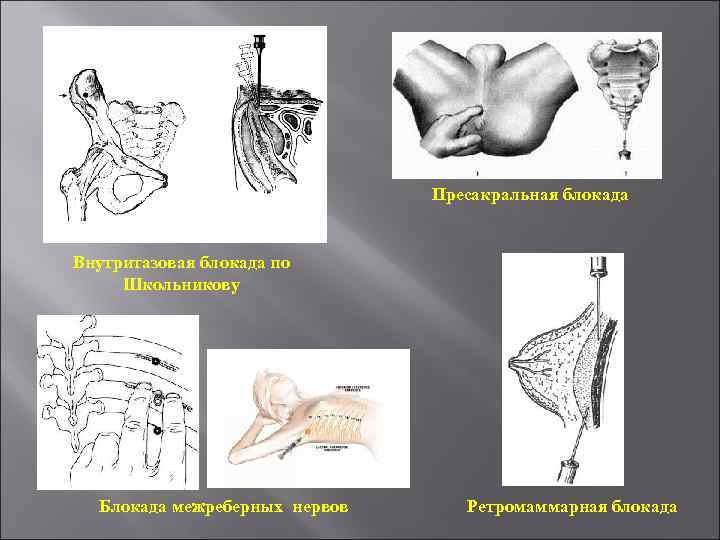 Пресакральная блокада Внутритазовая блокада по Школьникову Блокада межреберных нервов Ретромаммарная блокада 