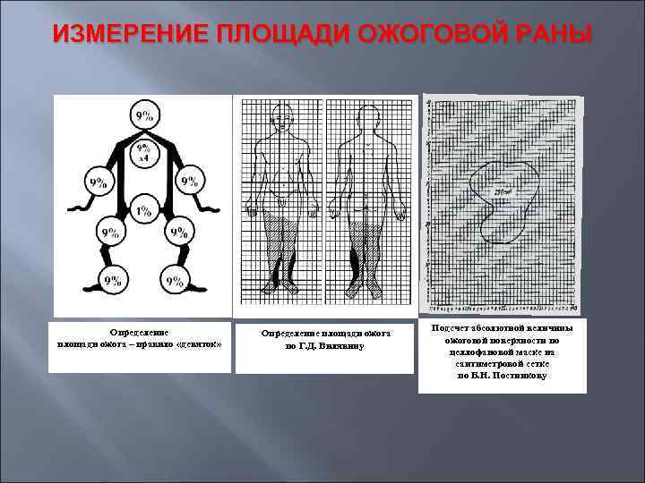 ИЗМЕРЕНИЕ ПЛОЩАДИ ОЖОГОВОЙ РАНЫ Определение площади ожога – правило «девяток» Определение площади ожога по