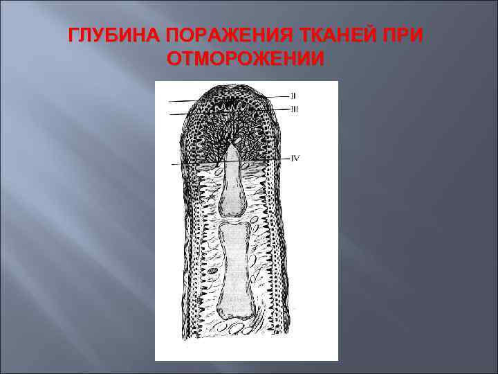 ГЛУБИНА ПОРАЖЕНИЯ ТКАНЕЙ ПРИ ОТМОРОЖЕНИИ 