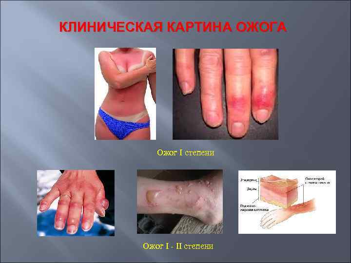 КЛИНИЧЕСКАЯ КАРТИНА ОЖОГА Ожог I степени Ожог I - II степени 