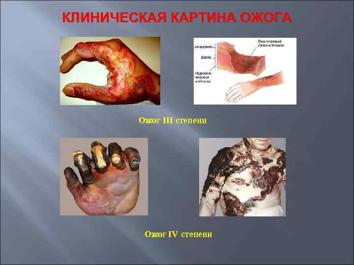 КЛИНИЧЕСКАЯ КАРТИНА ОЖОГА Ожог III степени Ожог IV степени 