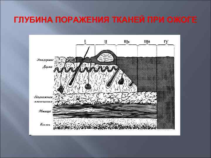 ГЛУБИНА ПОРАЖЕНИЯ ТКАНЕЙ ПРИ ОЖОГЕ 