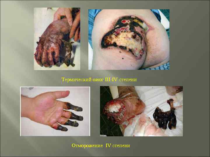 Термический ожог III-IV степени Отморожение IV степени 