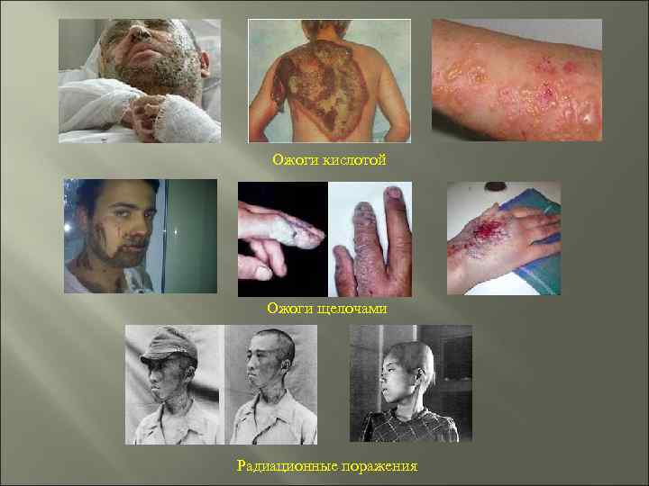 Ожоги кислотой Ожоги щелочами Радиационные поражения 