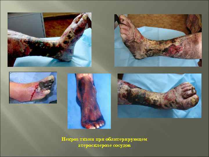 Некроз ткани при облитерирующем атеросклерозе сосудов 