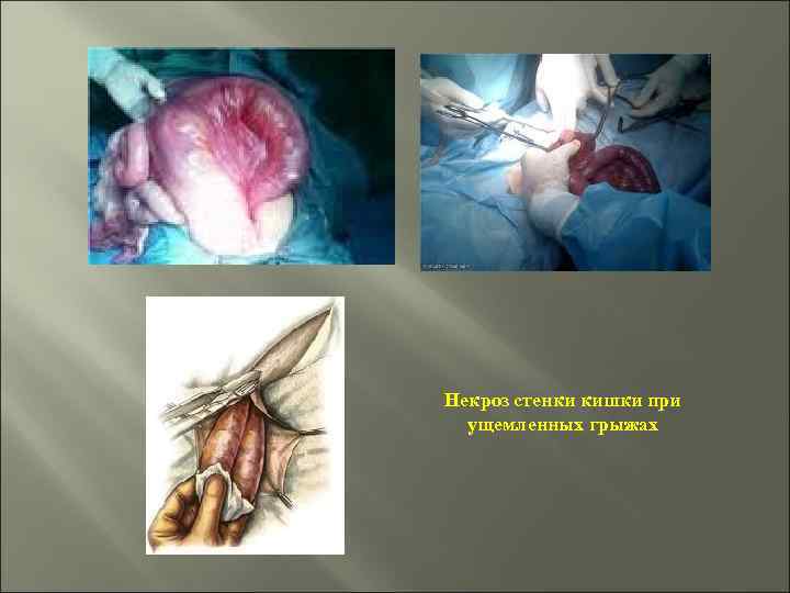 Некроз стенки кишки при ущемленных грыжах 