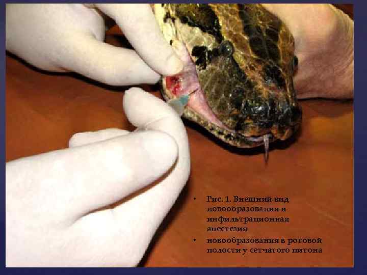  • • Рис. 1. Внешний вид новообразования и инфильтрационная анестезия новообразования в ротовой