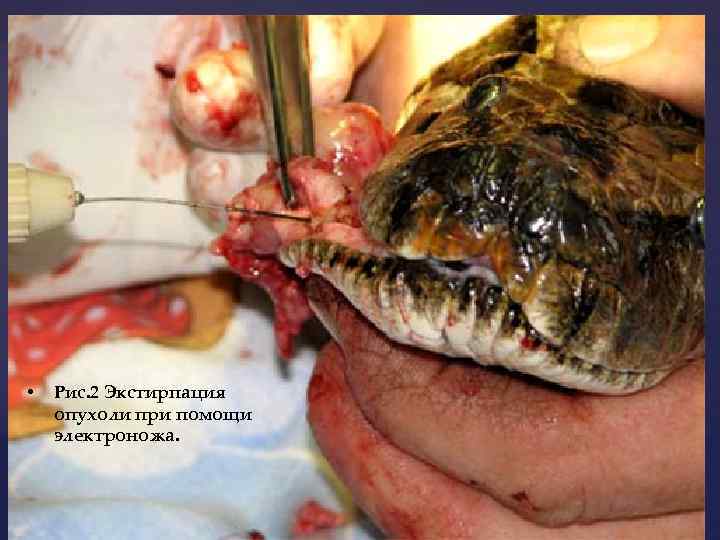  • Рис. 2 Экстирпация опухоли при помощи электроножа. 