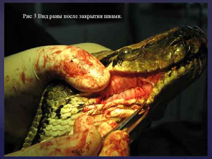 Рис 3 Вид раны после закрытия швами. 