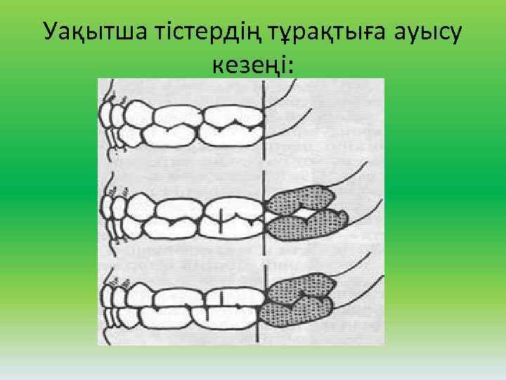 Уақытша тістердің тұрақтыға ауысу кезеңі: 