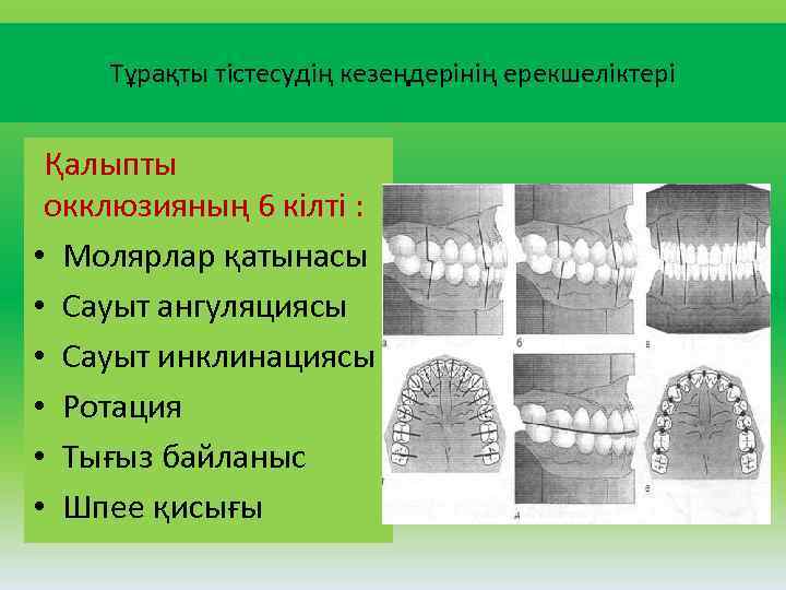 Тұрақты тістесудің кезеңдерінің ерекшеліктері Қалыпты окклюзияның 6 кілті : • Молярлар қатынасы • Сауыт