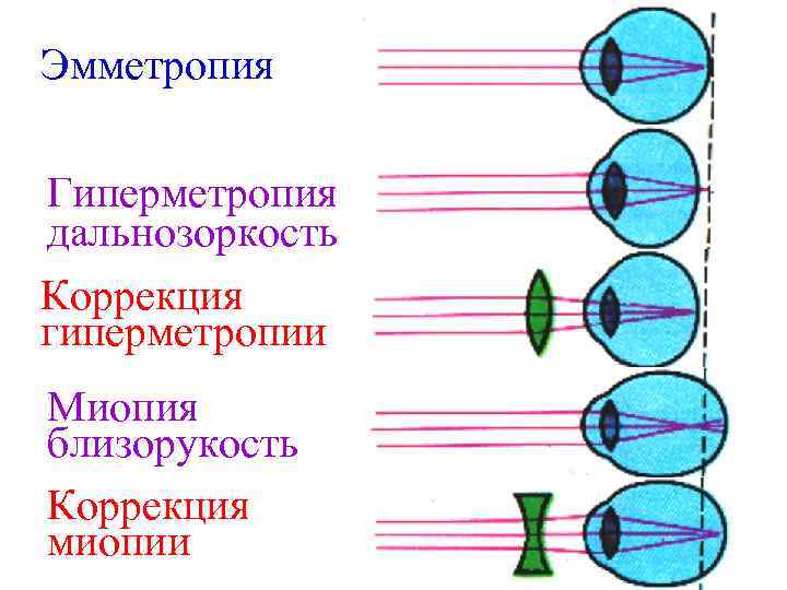 Эмметропия Гиперметропия дальнозоркость Коррекция гиперметропии Миопия близорукость Коррекция миопии 