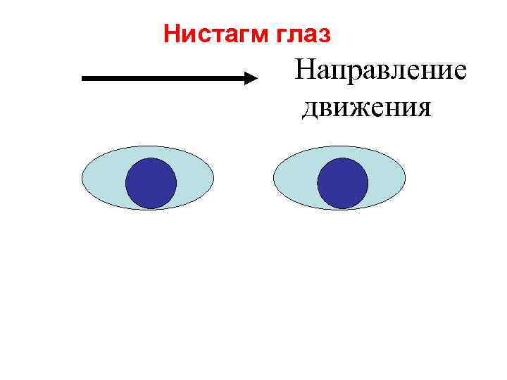 Нистагм глаз Направление движения 