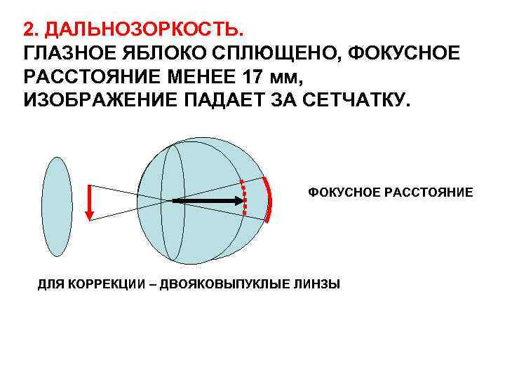2. ДАЛЬНОЗОРКОСТЬ. ГЛАЗНОЕ ЯБЛОКО СПЛЮЩЕНО, ФОКУСНОЕ РАССТОЯНИЕ МЕНЕЕ 17 мм, ИЗОБРАЖЕНИЕ ПАДАЕТ ЗА СЕТЧАТКУ.