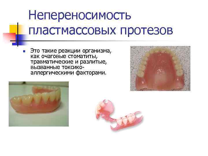 Непереносимость пластмассовых протезов n Это такие реакции организма, как очаговые стоматиты, травматические и разлитые,