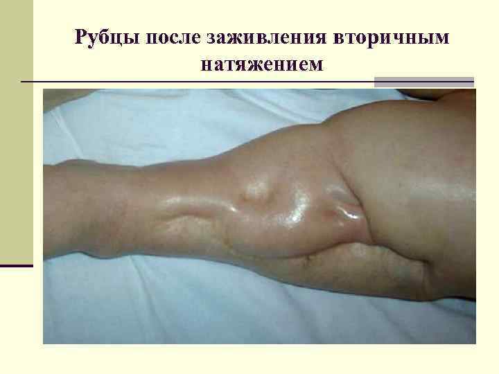 Рубцы после заживления вторичным натяжением 