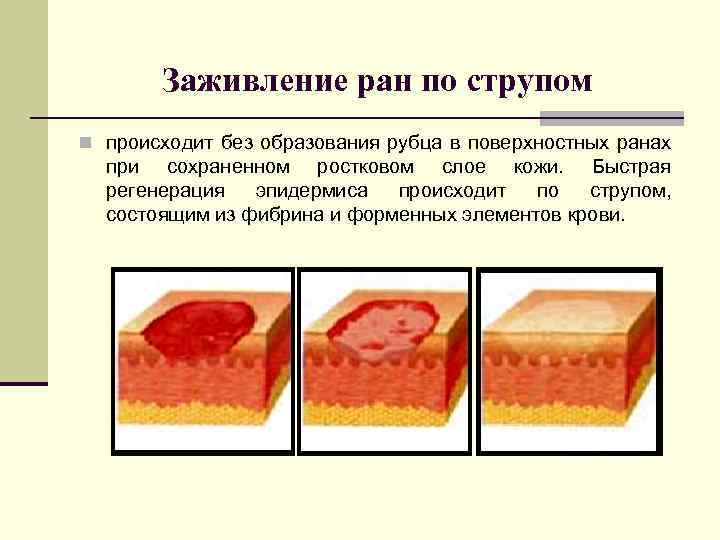 Заживление ран по струпом n происходит без образования рубца в поверхностных ранах при сохраненном