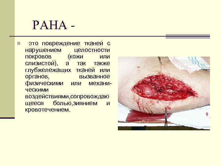 РАНА n это повреждение тканей с нарушением целостности покровов (кожи или слизистой), а также
