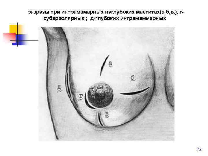 разрезы при интрамамарных неглубоких маститах(а, б, в. ), гсубареолярных ; д-глубоких интрамаммарных 72 