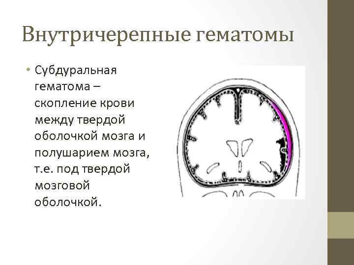 Внутричерепные гематомы • Субдуральная гематома – скопление крови между твердой оболочкой мозга и полушарием