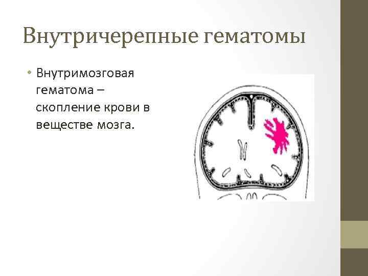 Внутричерепные гематомы • Внутримозговая гематома – скопление крови в веществе мозга. 