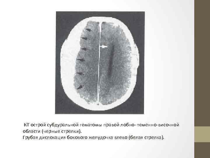 КТ острой субдуральной гематомы правой лобно- теменно-височной области (черные стрелки). Грубая дислокация бокового желудочка