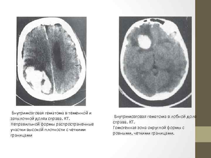 Внутримозговая гематома в теменной и затылочной долях справа. КТ. Неправильной формы распространенные участки высокой