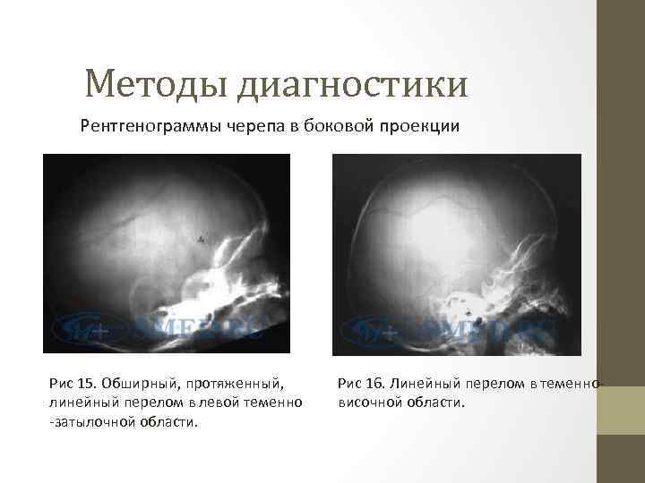 Методы диагностики Рентгенограммы черепа в боковой проекции Рис 15. Обширный, протяженный, линейный перелом в