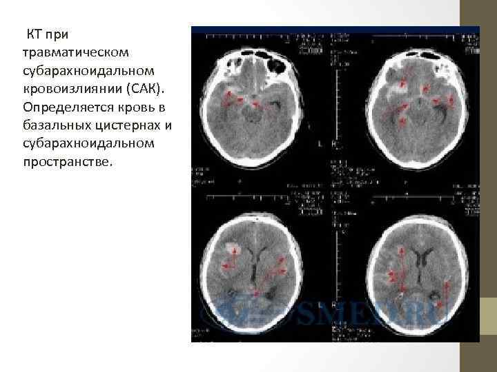 КТ при травматическом субарахноидальном кровоизлиянии (САК). Определяется кровь в базальных цистернах и субарахноидальном пространстве.