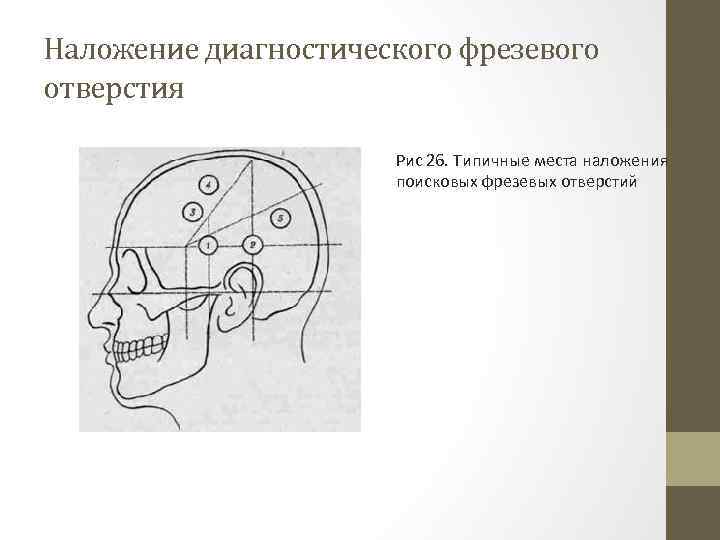 Наложение диагностического фрезевого отверстия Рис 26. Типичные места наложения поисковых фрезевых отверстий 