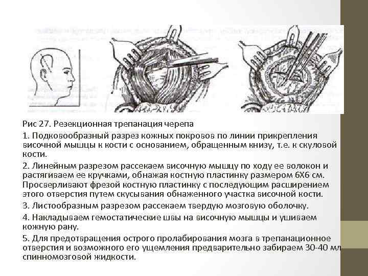 Рис 27. Резекционная трепанация черепа 1. Подковообразный разрез кожных покровов по линии прикрепления височной