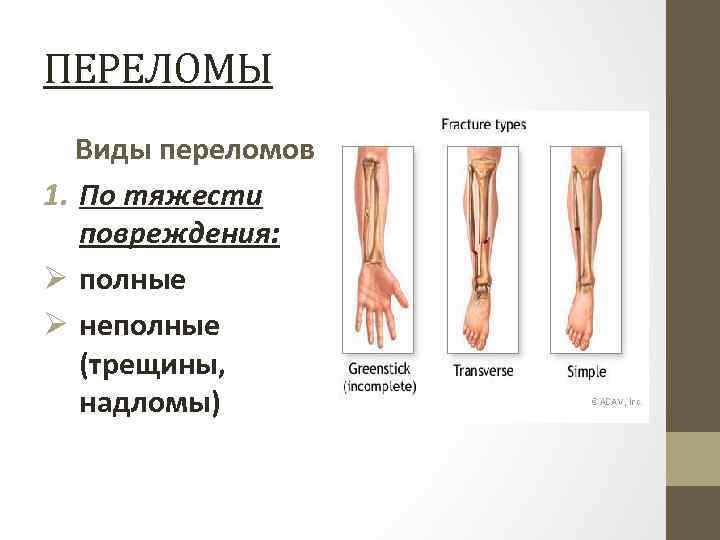 ПЕРЕЛОМЫ Виды переломов 1. По тяжести повреждения: Ø полные Ø неполные (трещины, надломы) 