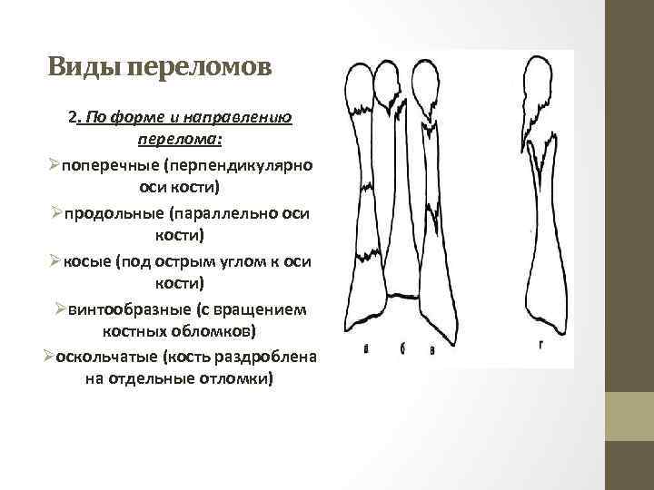 Виды переломов 2. По форме и направлению перелома: Øпоперечные (перпендикулярно оси кости) Øпродольные (параллельно