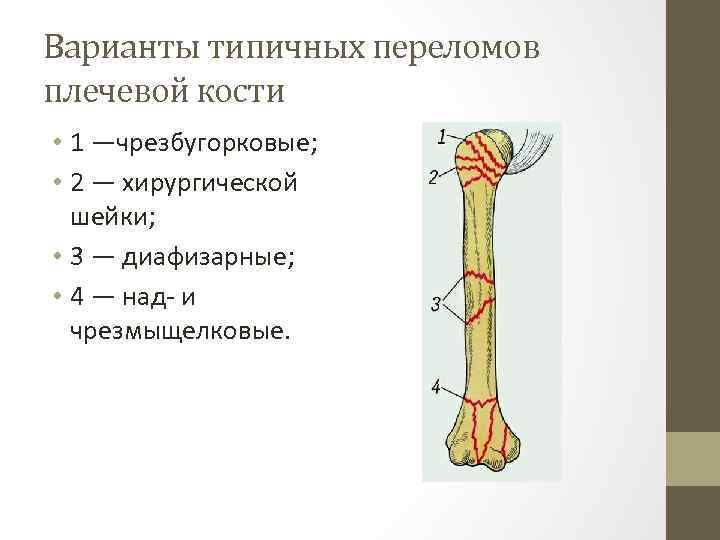 Переломы плечевой кости презентация