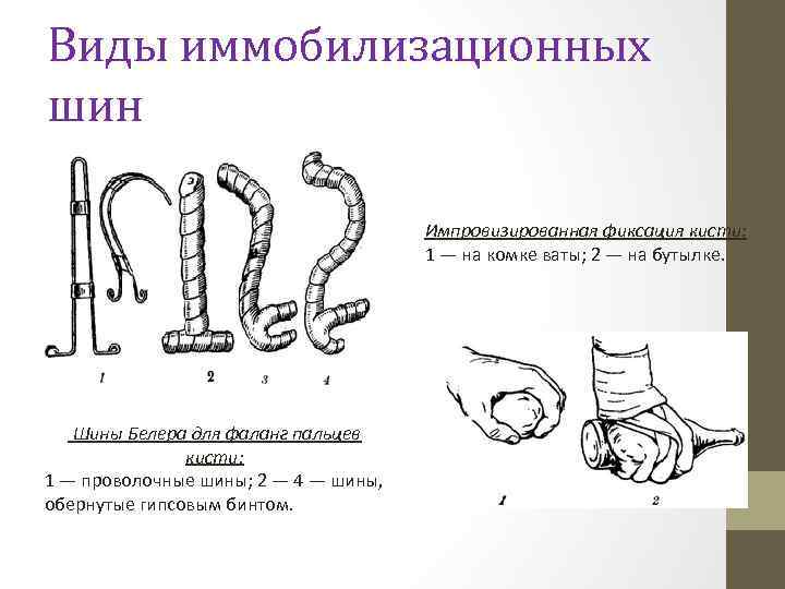 Виды иммобилизационных шин Импровизированная фиксация кисти: 1 — на комке ваты; 2 — на