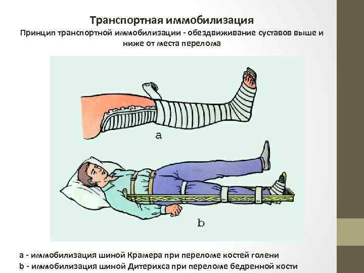 Транспортная иммобилизация Принцип транспортной иммобилизации - обездвиживание суставов выше и ниже от места перелома