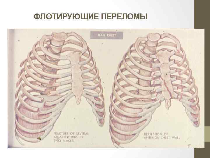 Перелом ребер локальный