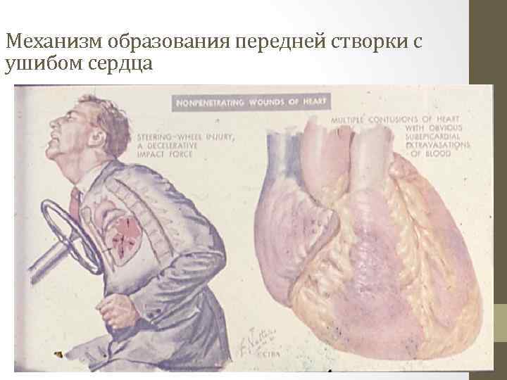 Механизм образования передней створки с ушибом сердца 