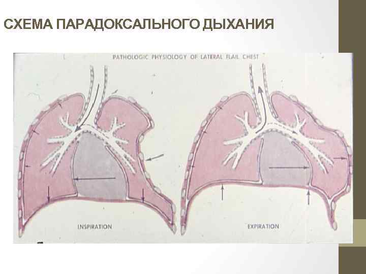 СХЕМА ПАРАДОКСАЛЬНОГО ДЫХАНИЯ 