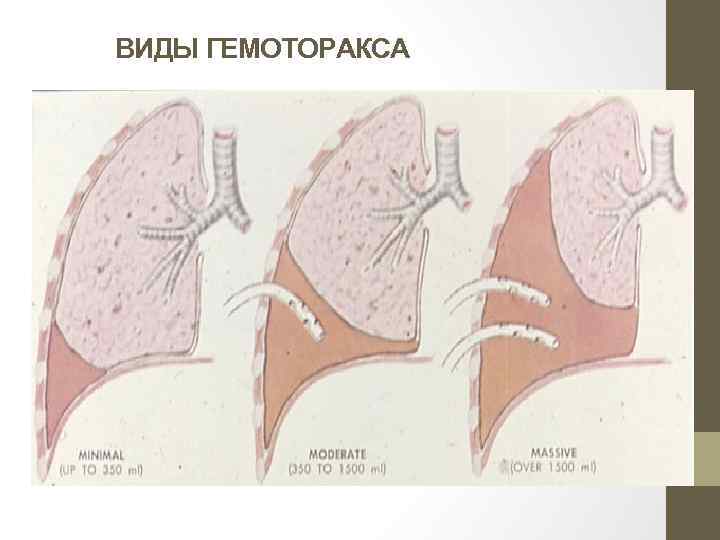 Презентация пневмоторакс и гемоторакс