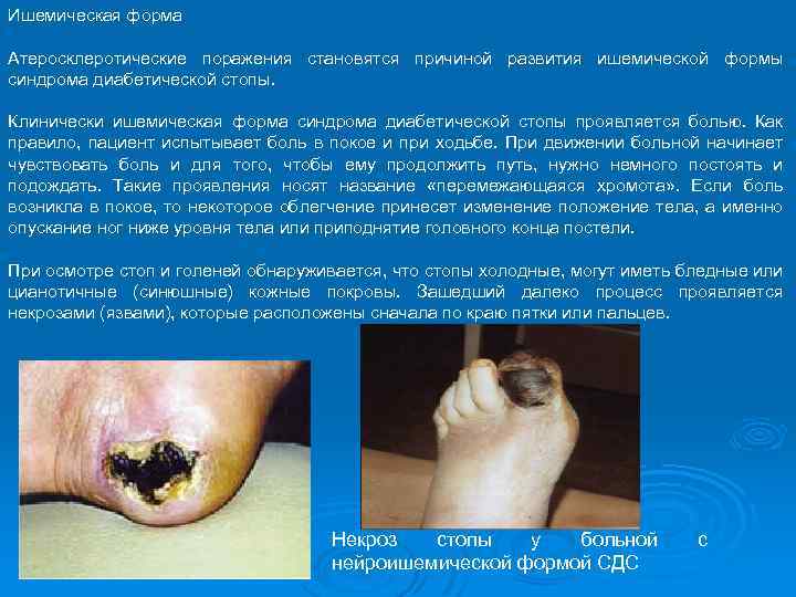 Ишемическая форма Атеросклеротические поражения становятся причиной развития ишемической формы синдрома диабетической стопы. Клинически ишемическая